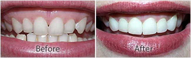 Teeth Whitening before and after results of real patient 2 near Lawrence, KS
