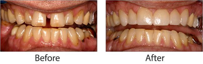 Dental Implants before and after results of real patient 1 near Lawrence, KS