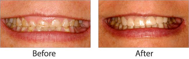 Cosmetic dentistry before and after 06