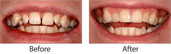 Dental Impalants before and after results of real patient 2 near Lawrence, KS