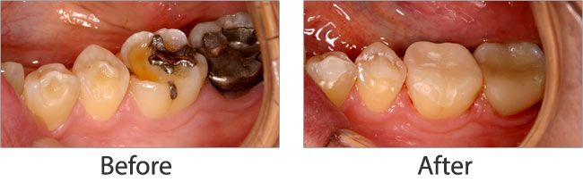 Mercury Safe Dentistry before and after 02