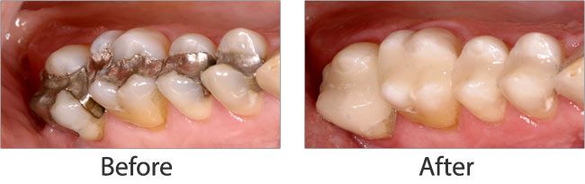 Mercury Safe Dentistry before and after results of real patient 2 near Lawrence, KS