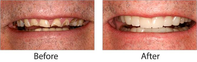 Cosmetic dentistry before and after 07