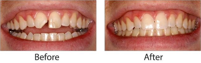 Dental Impalants before and after results of real patient 4 near Lawrence, KS