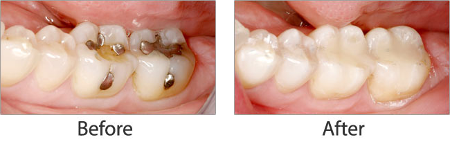 Mercury Safe Dentistry before and after 04