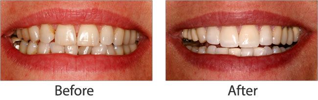 Teeth Whitening before and after results of real patient 1 near Lawrence, KS