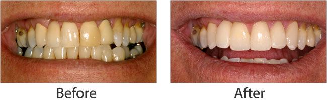 Teeth Whitening before and after 03