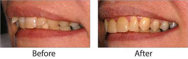 Dental Impalants before and after results of real patient 5 near Lawrence, KS