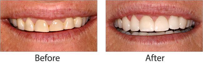 Teeth Whitening before and after results of real patient 3 near Lawrence, KS