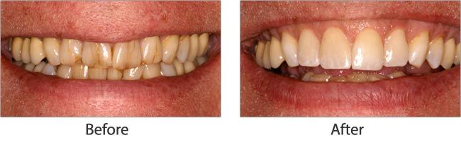 cosmetic dentistry before and after results of real patient 1 near Lawrence, KS