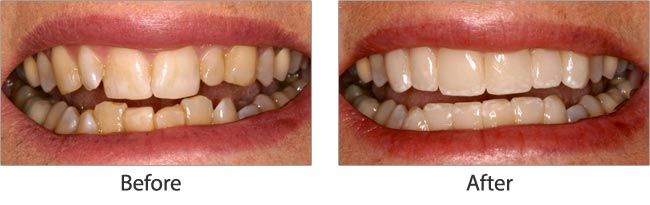 cosmetic dentistry before and after 02