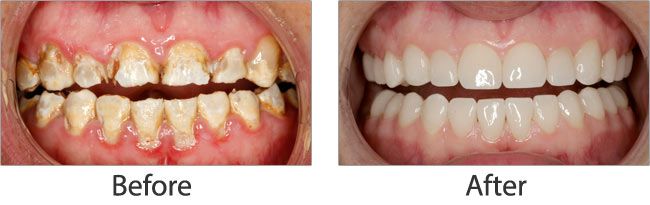 cosmetic dentistry before and after results of real patient 2 near Lawrence, KS