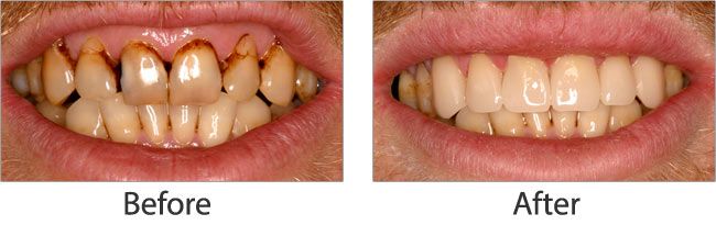cosmetic dentistry before and after 04