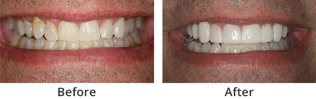 Smile Rejuvenation  before and after results of real patient 1 near Lawrence, KS