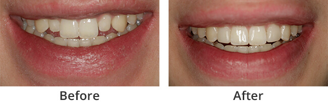 Smile Rejuvenation  before and after 03